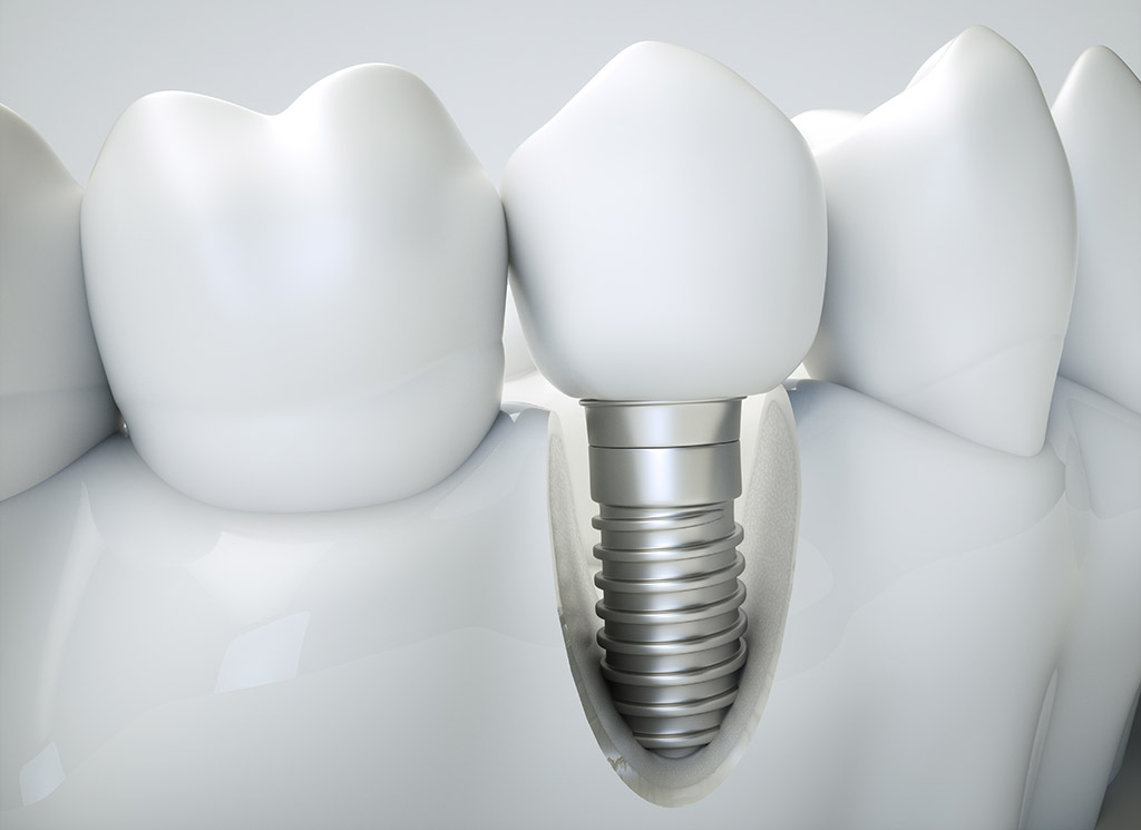Implantes Dentales De Carga Inmediata Instituto Neofacial