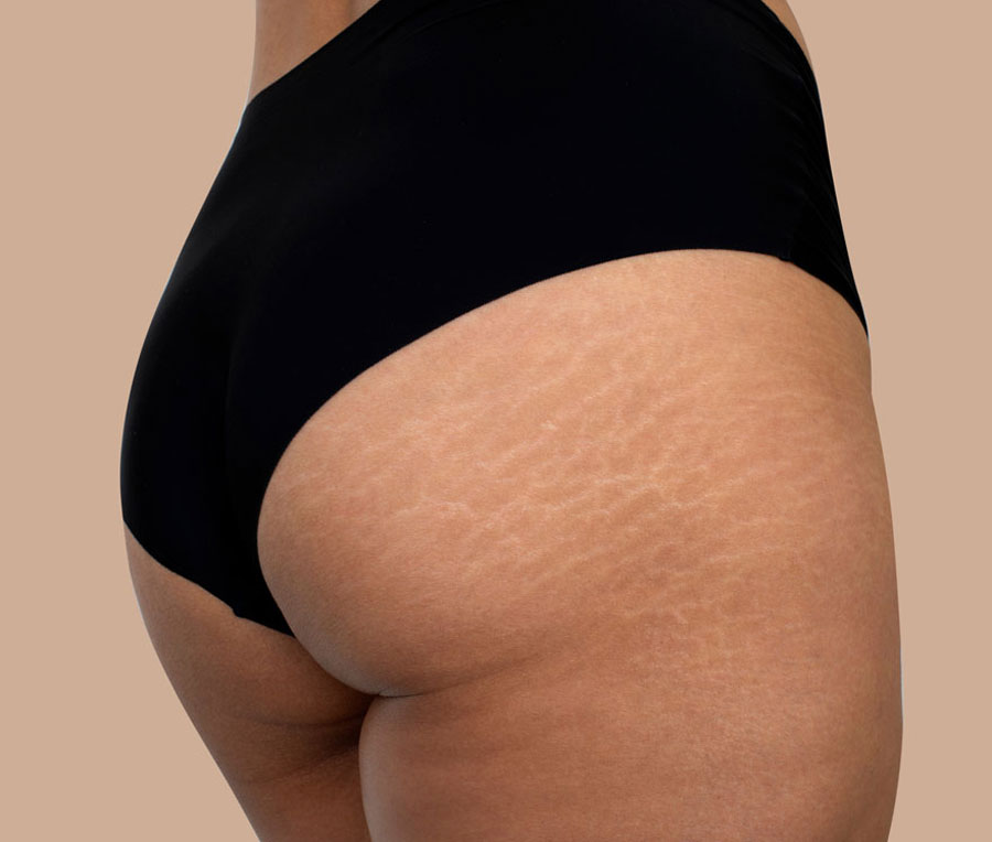 caso-antes-tratamiento-celulitis