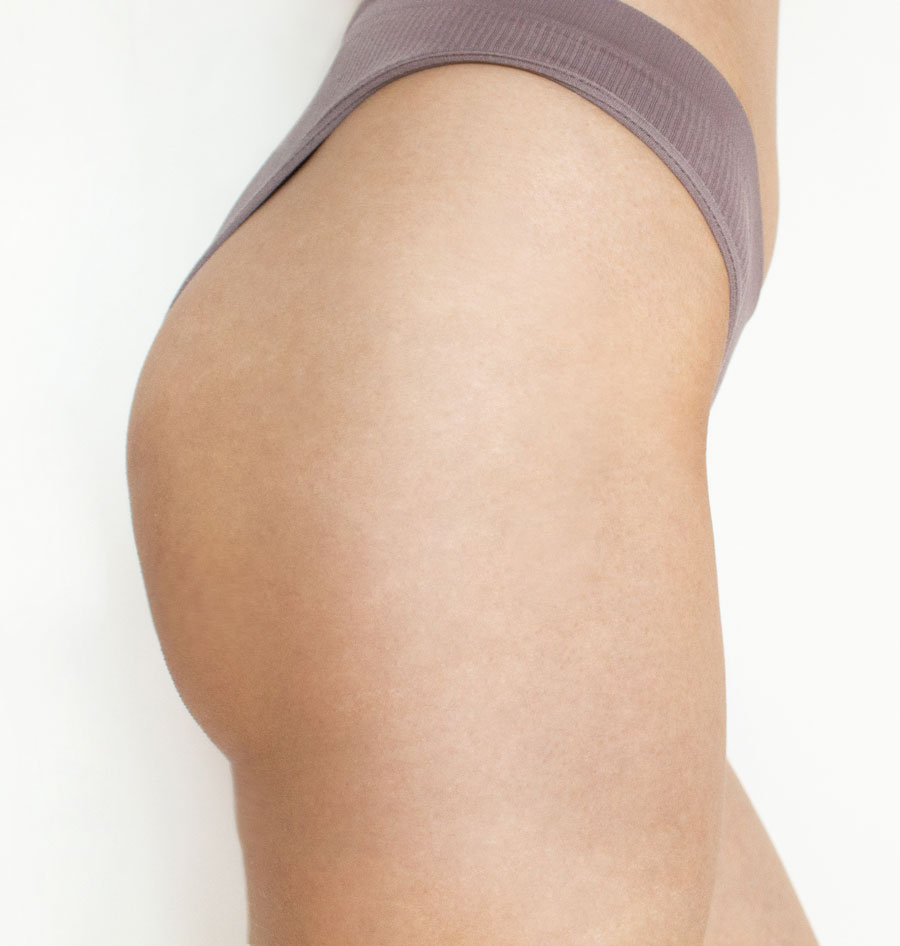 gluteos-despues-tratamiento-carboxiterapia