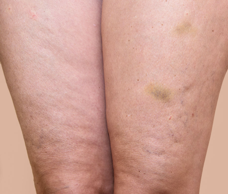 piernas-con-celulitis-antes-carboxiterapia