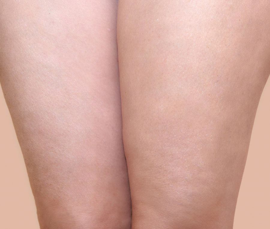 piernas-con-celulitis-despues-carboxiterapia