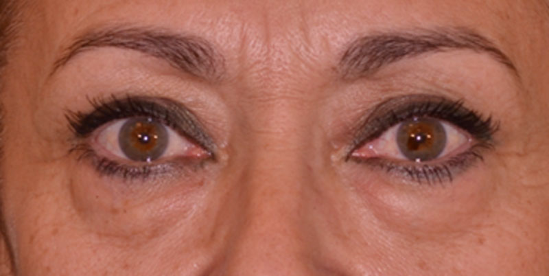 caso-blefaroplastia-1-antes