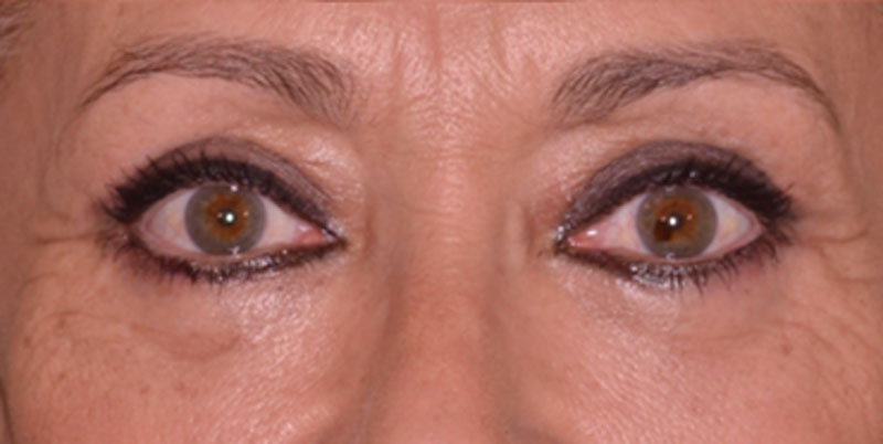 caso-blefaroplastia-1-despues