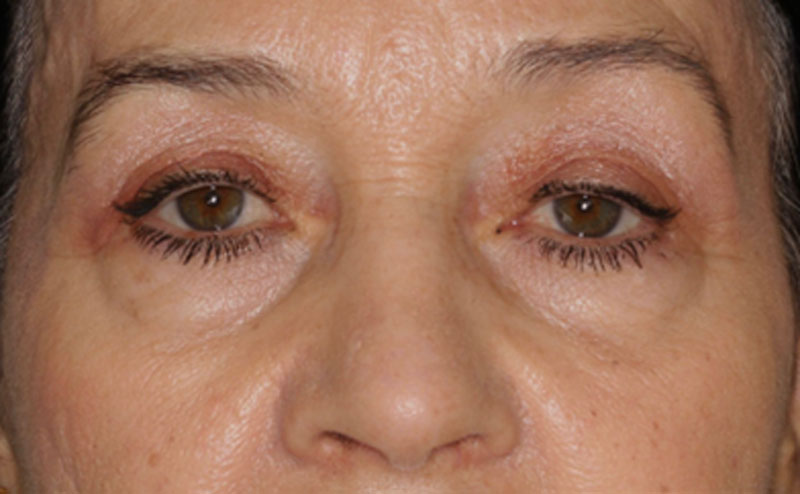 caso-blefaroplastia-antes