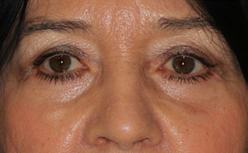 caso-blefaroplastia-despues